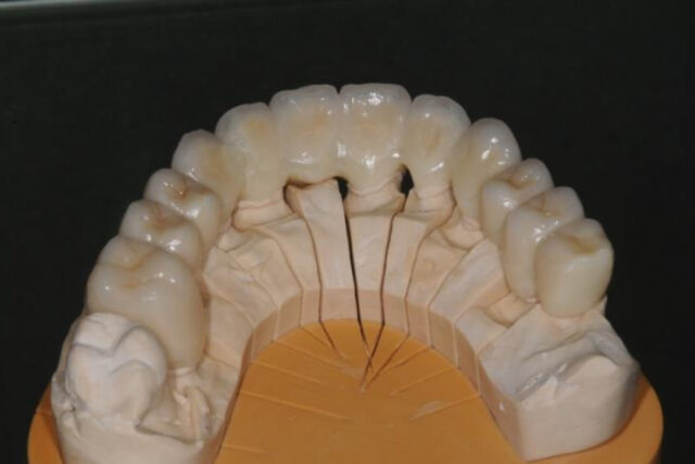 画像：ジルコニアキーウェイ臨床