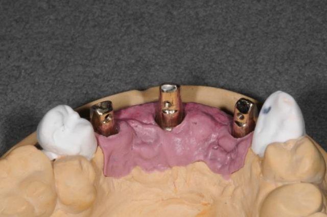 画像：インプラントサイドスクリューの臨床