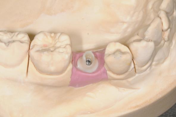 画像：ジルコニア アバットメント