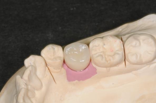 画像：e.max クラウン（外冠）