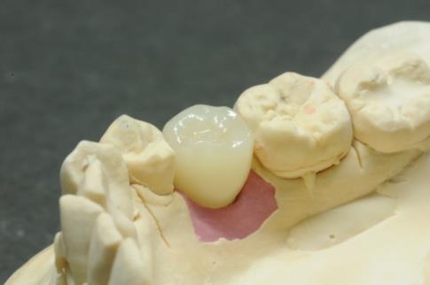 画像：e.max クラウン（外冠）