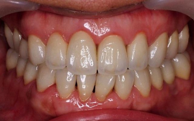 画像：ジルコニア臨床