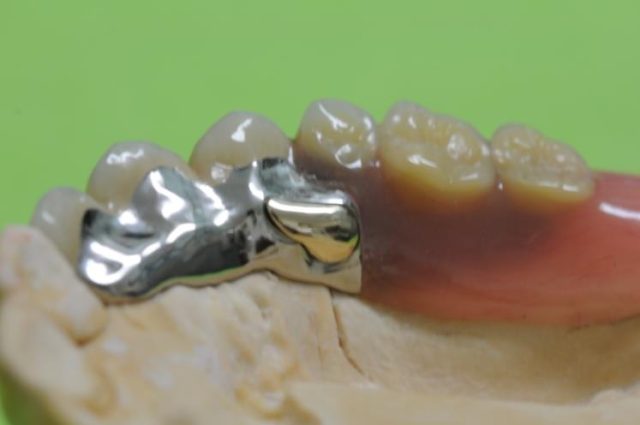 画像：リーゲルアタッチメントの臨床