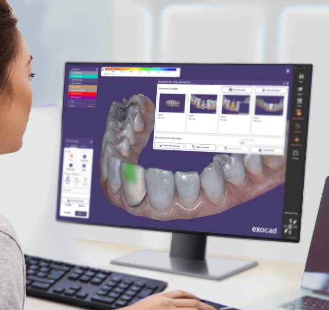 exocad（データ受注受付中です！)