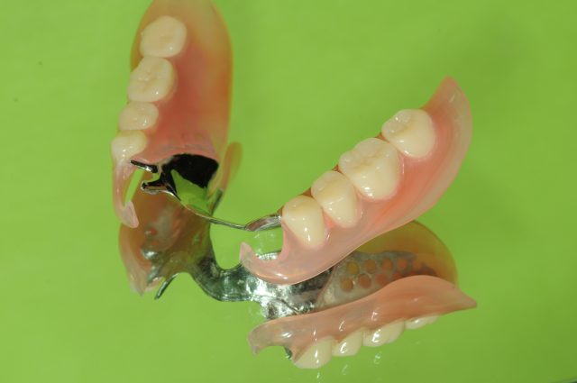 画像：ノンクラスプデンチャー