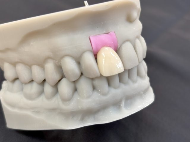 画像：インプラントジルコニアクラウン(口腔内スキャナーより製作)